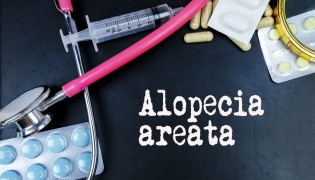 Was ist Alopecia Areata und wie wird es behandelt?