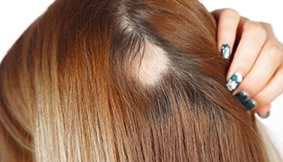 Was ist Alopecia Areata und wie wird es behandelt?